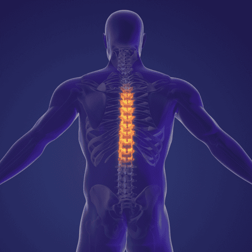 Avoid Long Wait Times for Spinal Fusion Surgery and Discectomy: Choose Mexico